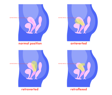 Can I Use a Menstrual Cup With a Tilted Uterus?