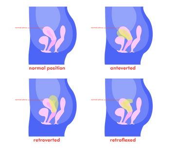 Can I Use a Menstrual Cup With a Tilted Uterus?