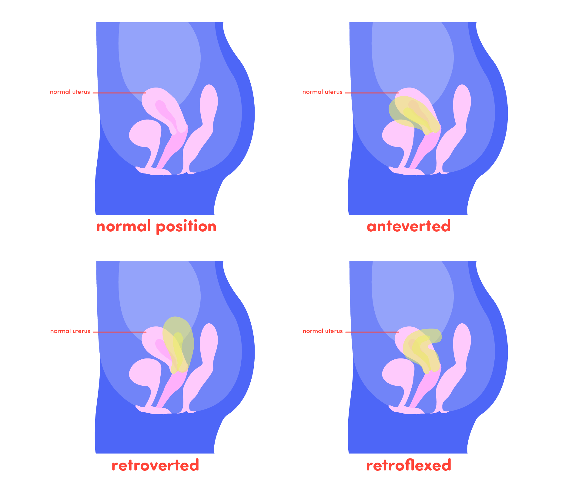 Can I Use a Menstrual Cup With a Tilted Uterus?